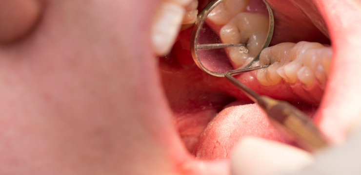 Modas peligrosas: ejercitador de mandíbula – Dental Moscardó