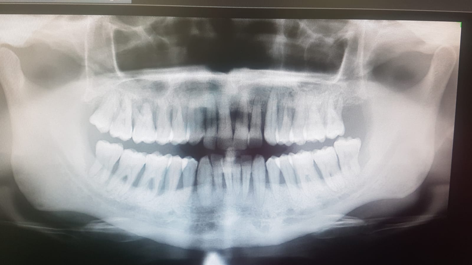 Modas peligrosas: ejercitador de mandíbula – Dental Moscardó